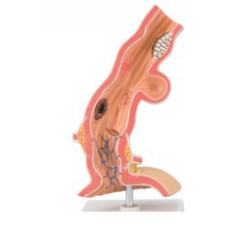 Pathological Model of Esophagus